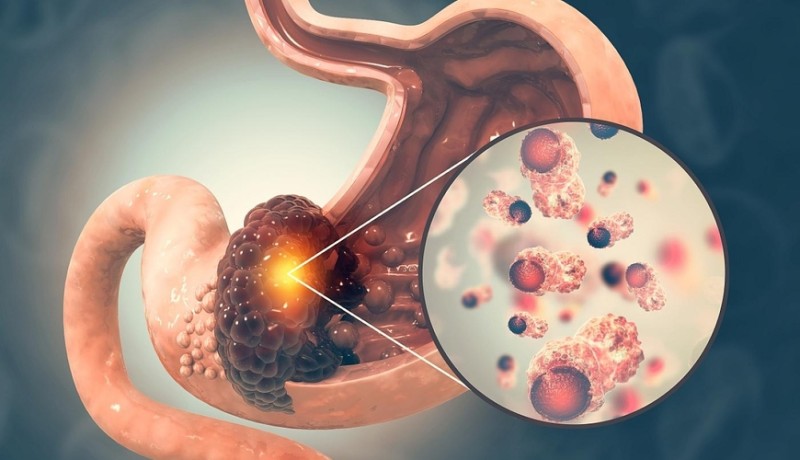 Mədə xərçəngi xəstələrinin 5 ortaq XÜSUSİYYƏTİ