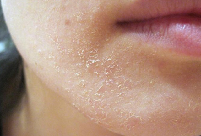 Dərimiz niyə QURUYUR?