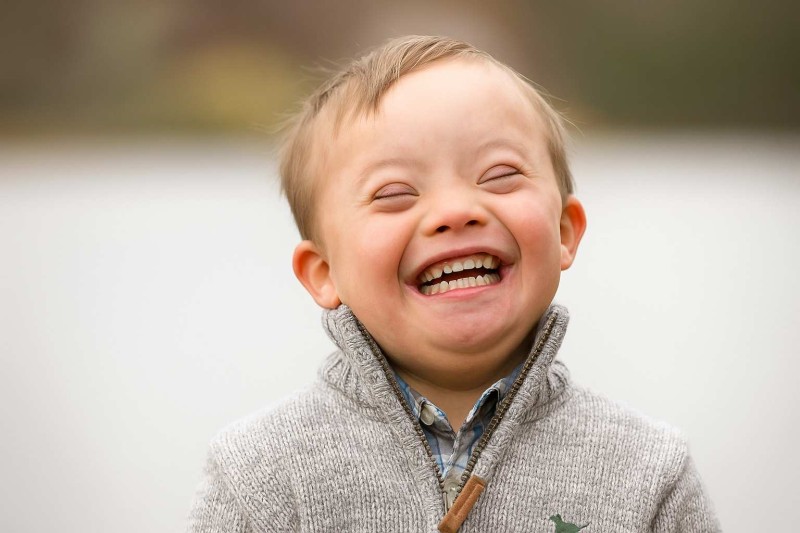 Daun sindromu haqqında qısa bələdçi: əlamətlər və tibbi yanaşma 