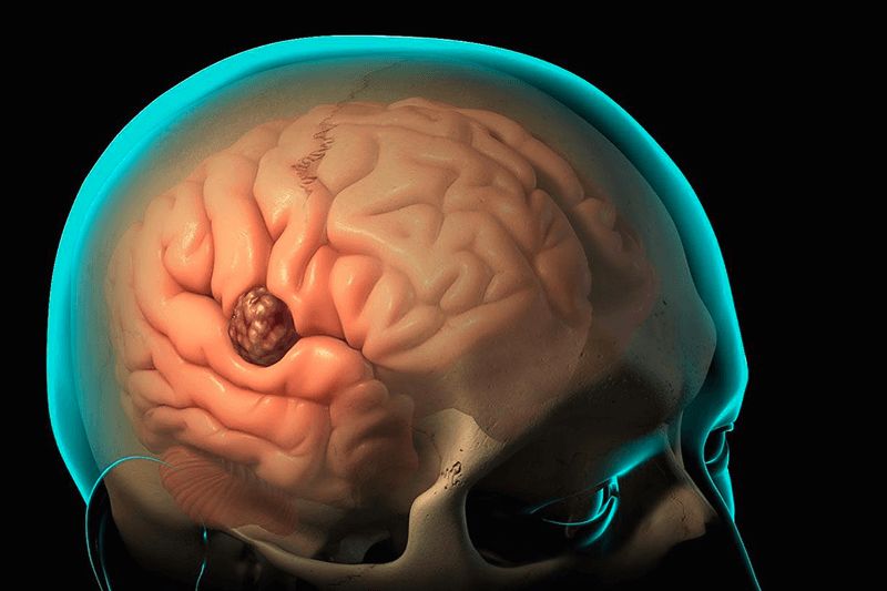 DİQQƏT : Bu simptomlar beyin şişindən xəbər verə bilər