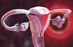 Polikistik over sindromu: qadınlarda əlamətlər və təbii dəstək üsulları