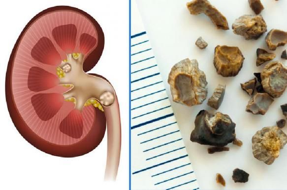 Böyrək daşı problemi: səbəblər, əlamətlər və dəstəkləyici üsullar