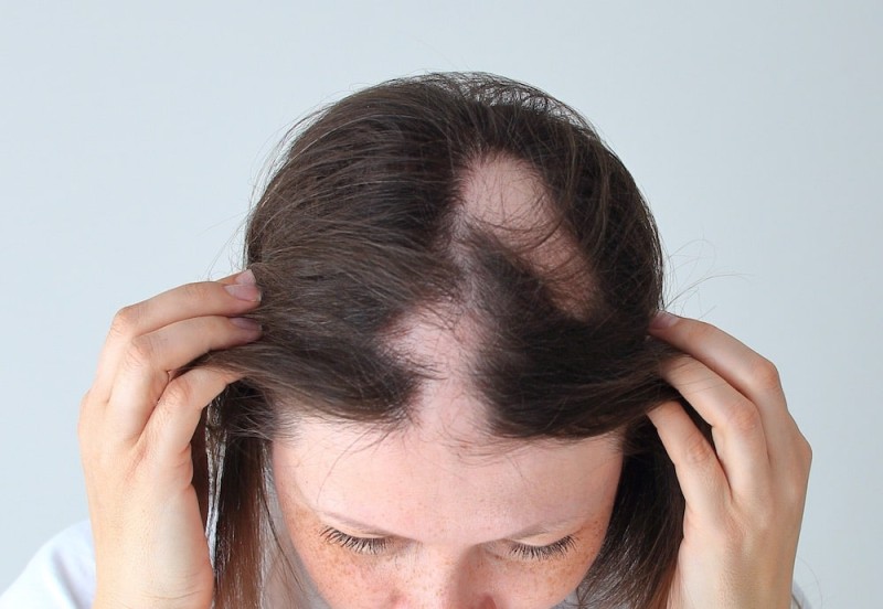 Alopesiya areata: qəfil saç tökülməsi nədən qaynaqlanır?