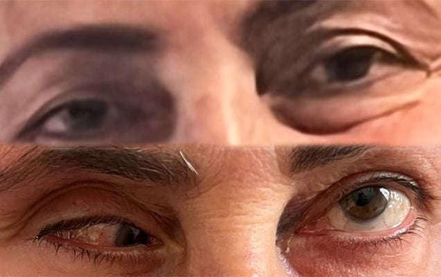 “Liman Klinikası” təzminat ödəyəcək: Burun düzəldəndə gözü zədələyib